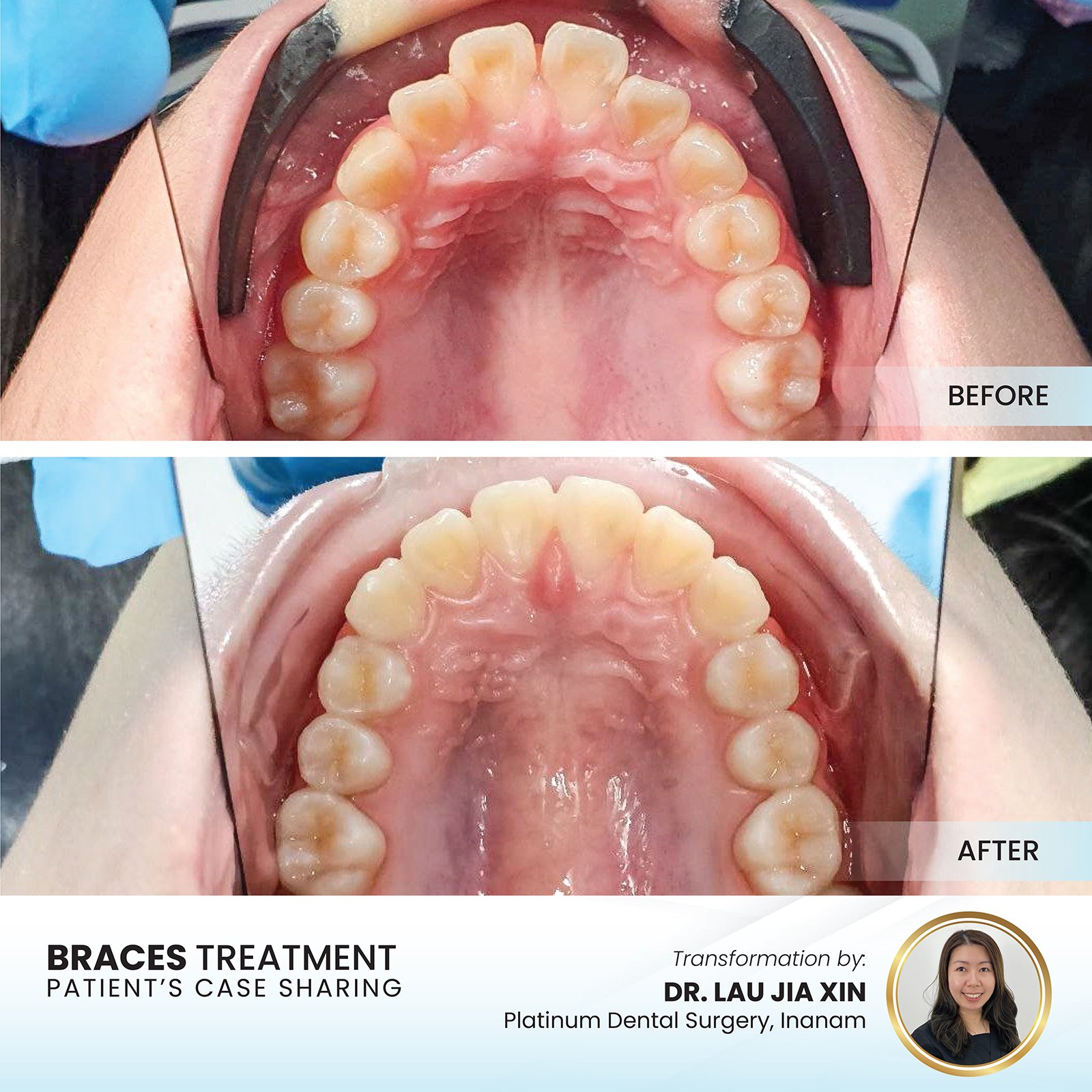 Patient smile transformation - Case II-26