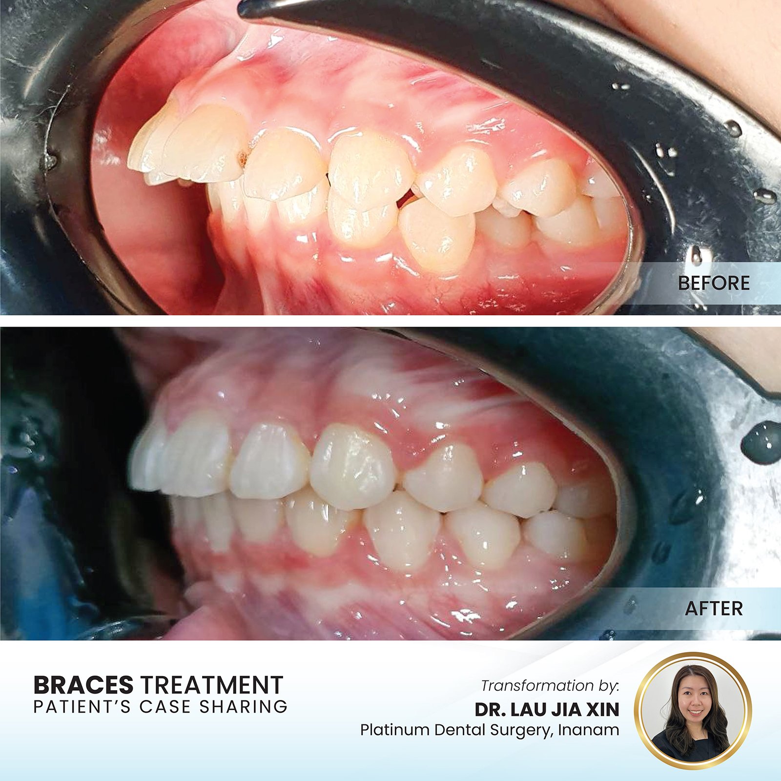 Patient smile transformation - Case II-27