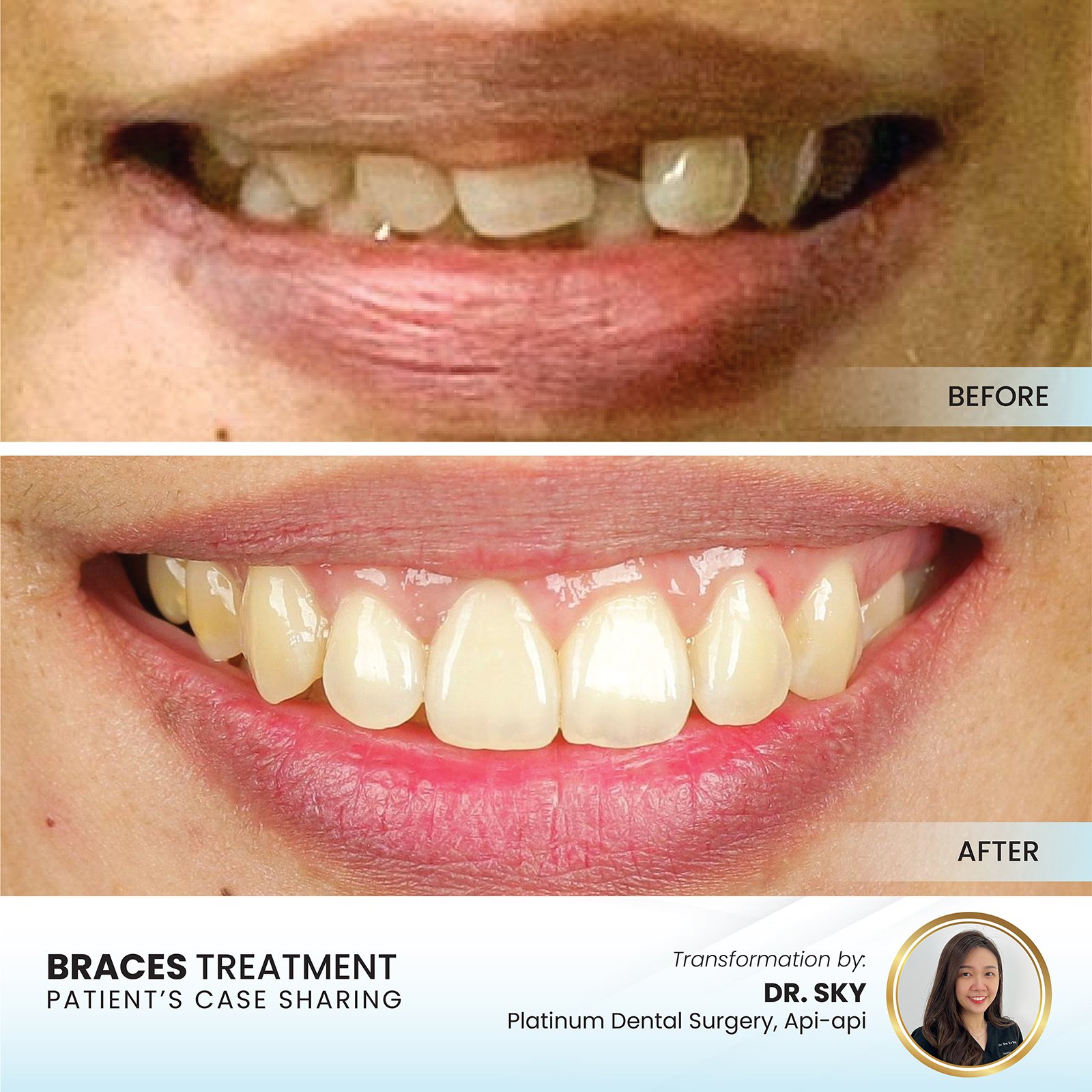 Patient smile transformation - Case II-3