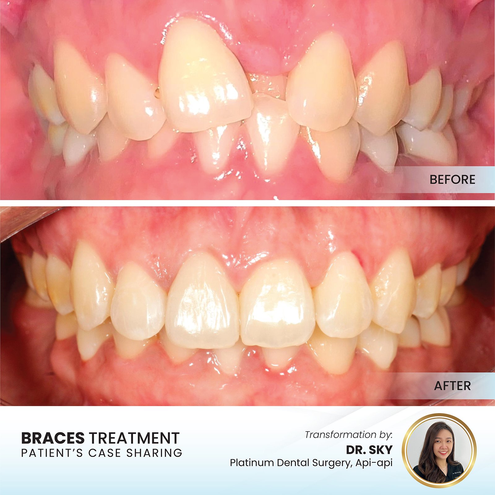 Braces before and after — spacing closed and teeth aligned, Platinum Dental Group Kota Kinabalu