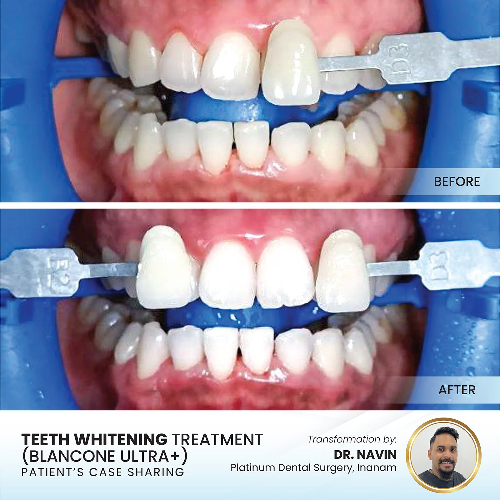 Patient smile transformation - Case II-5