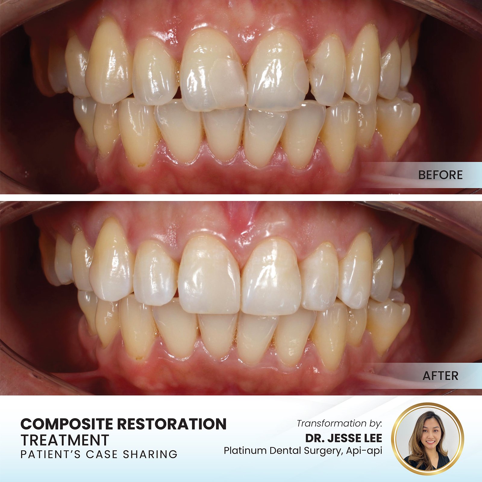 Patient smile transformation - Case II-6