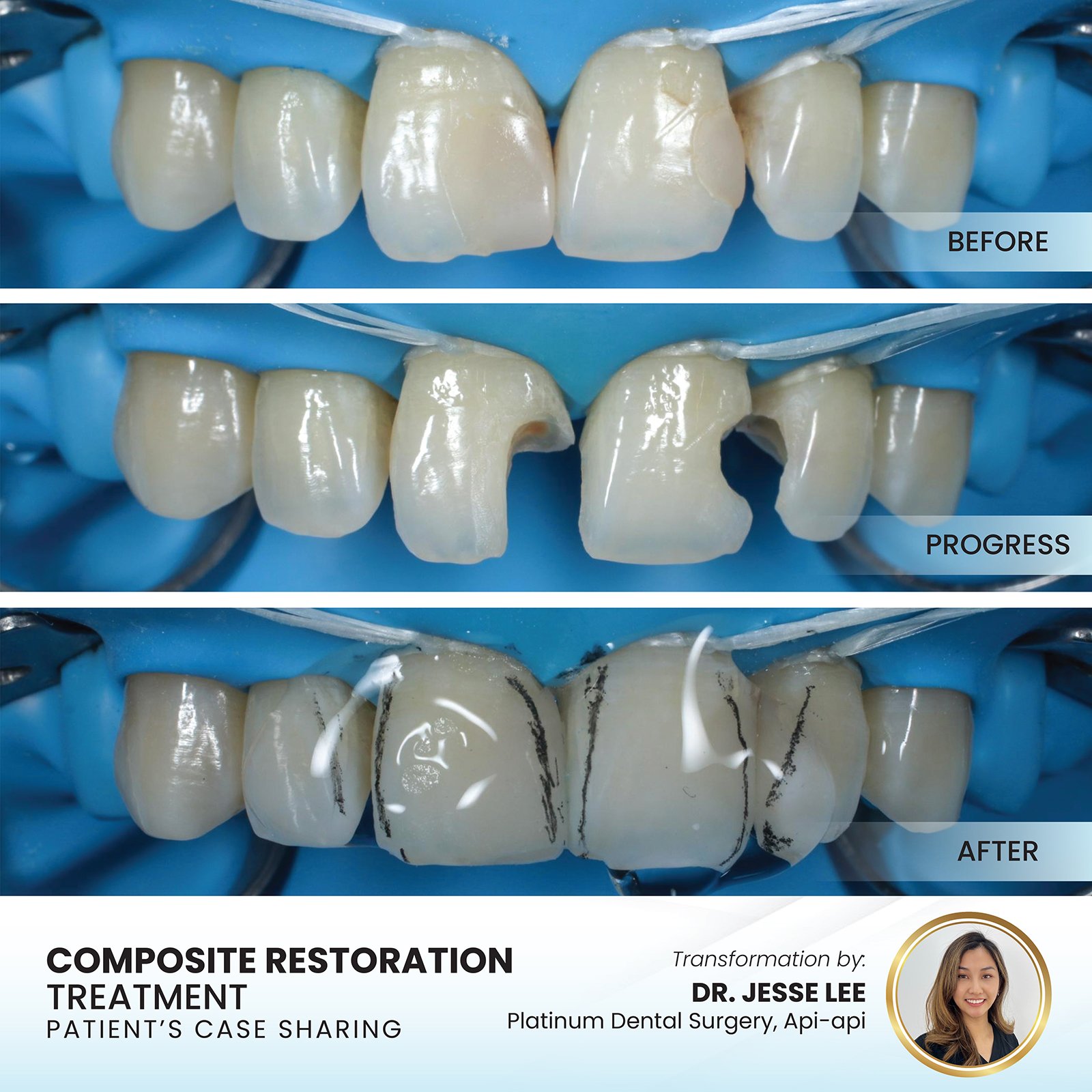 Patient smile transformation - Case II-7