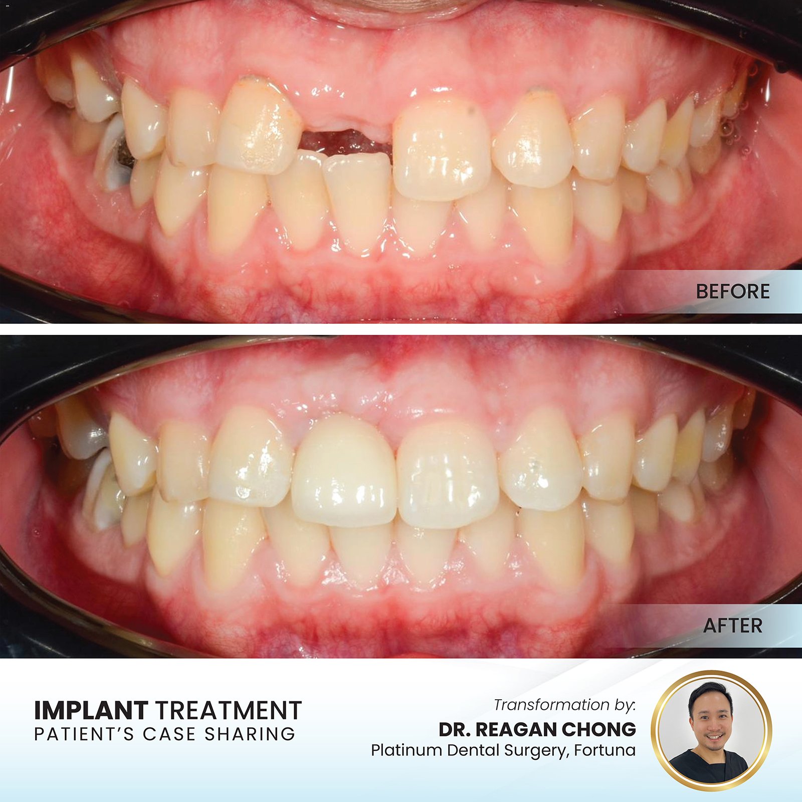 Real dental implant before and after case by Dr Reagan Chong at Platinum Dental Group