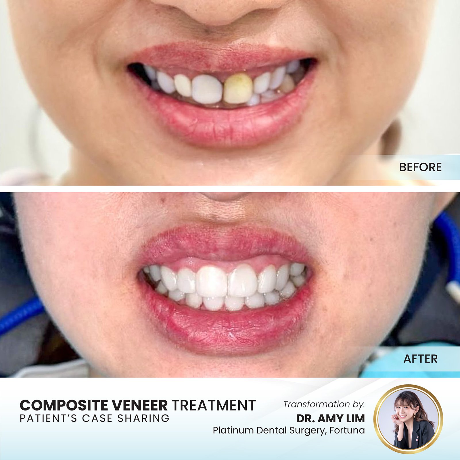 Patient smile transformation - Case III-1