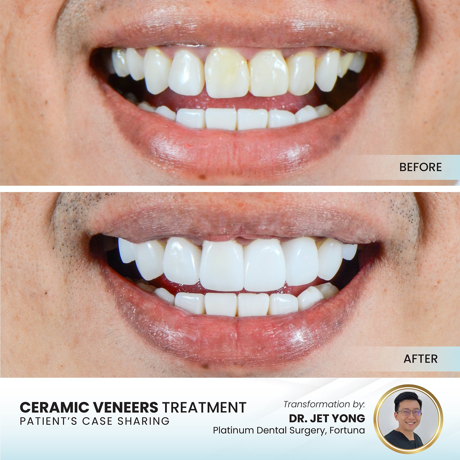 Patient smile transformation - Case III-10
