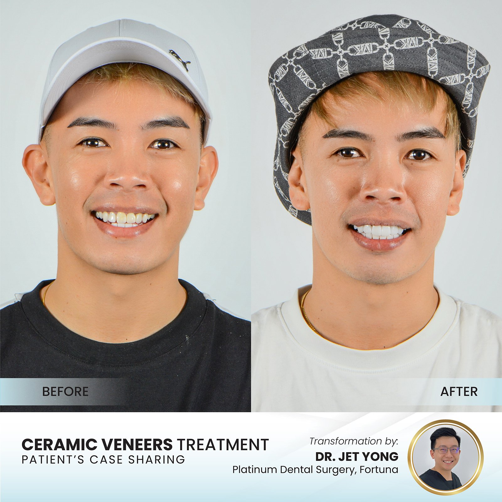 Patient smile transformation - Case III-11