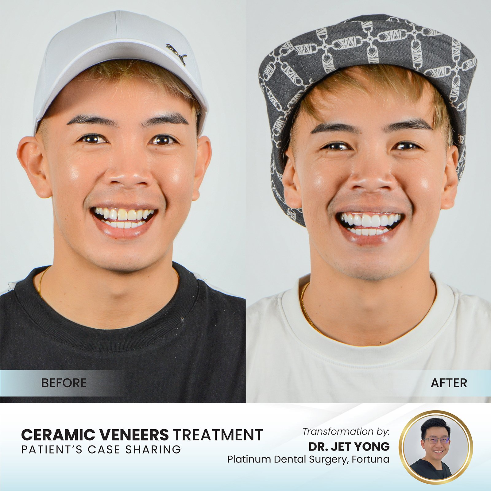 Patient smile transformation - Case III-12