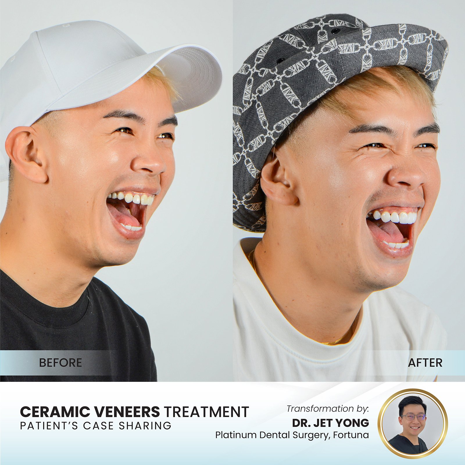 Patient smile transformation - Case III-13