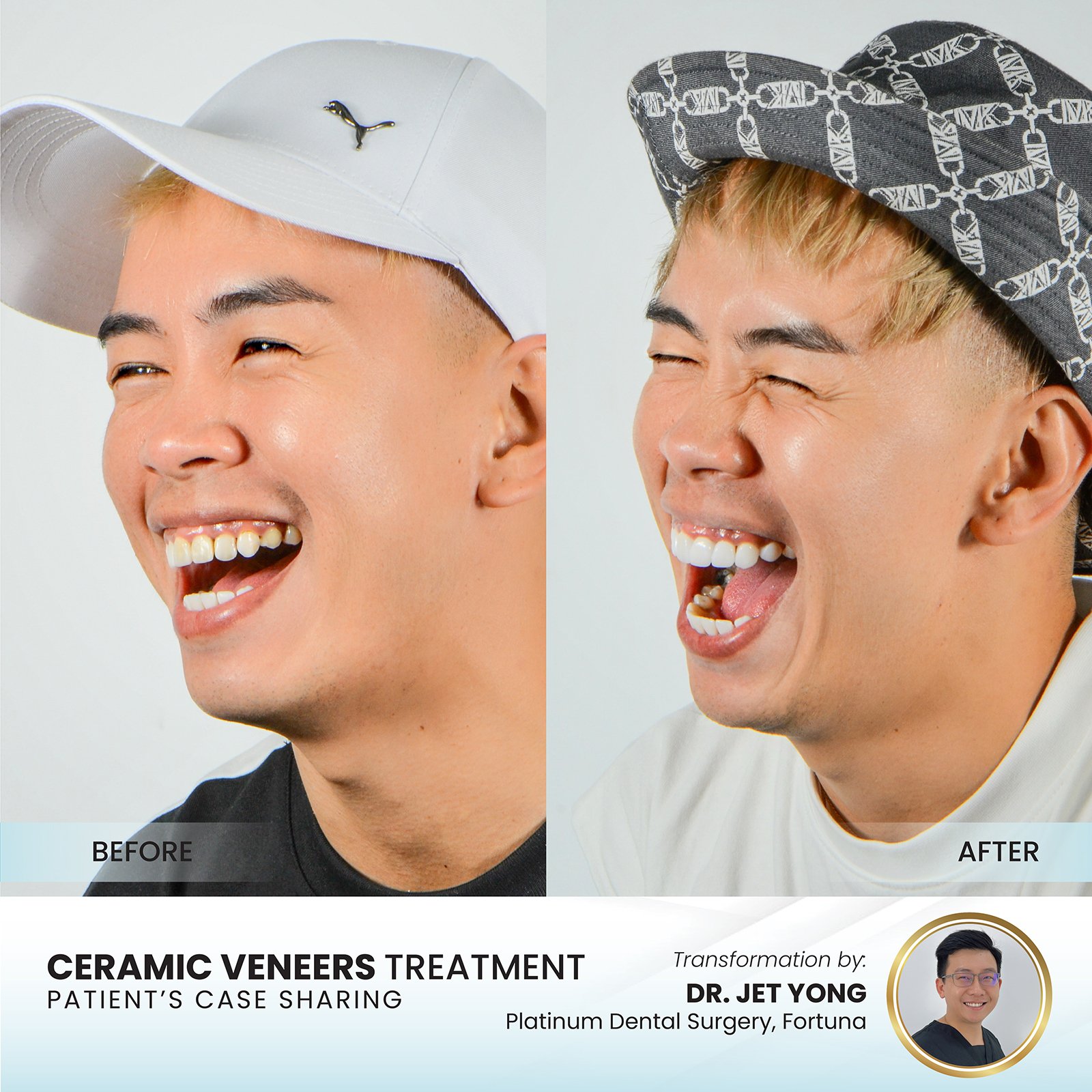 Patient smile transformation - Case III-14