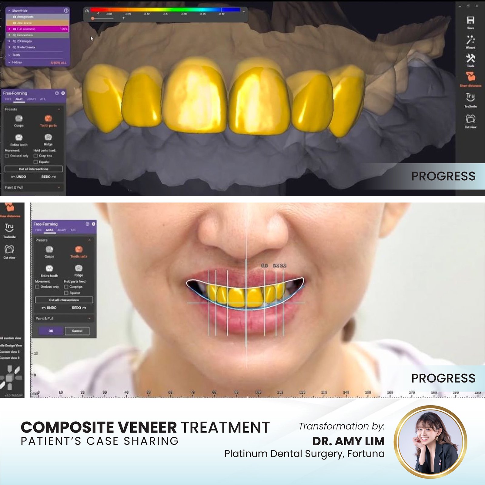 Patient smile transformation - Case III-2
