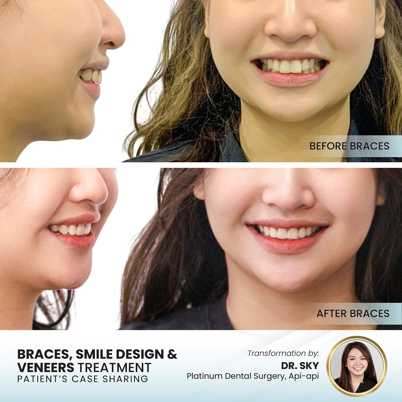 Patient smile transformation - Case III-3