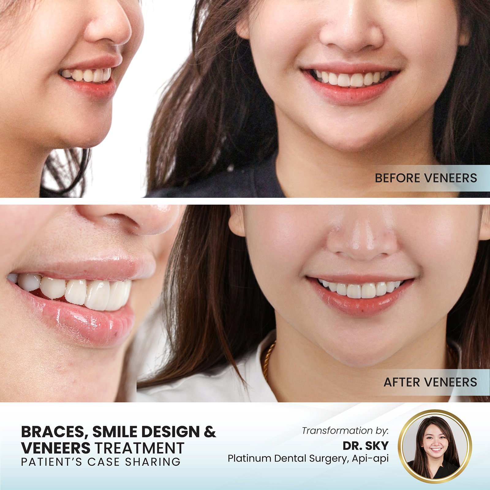 Patient smile transformation - Case III-4