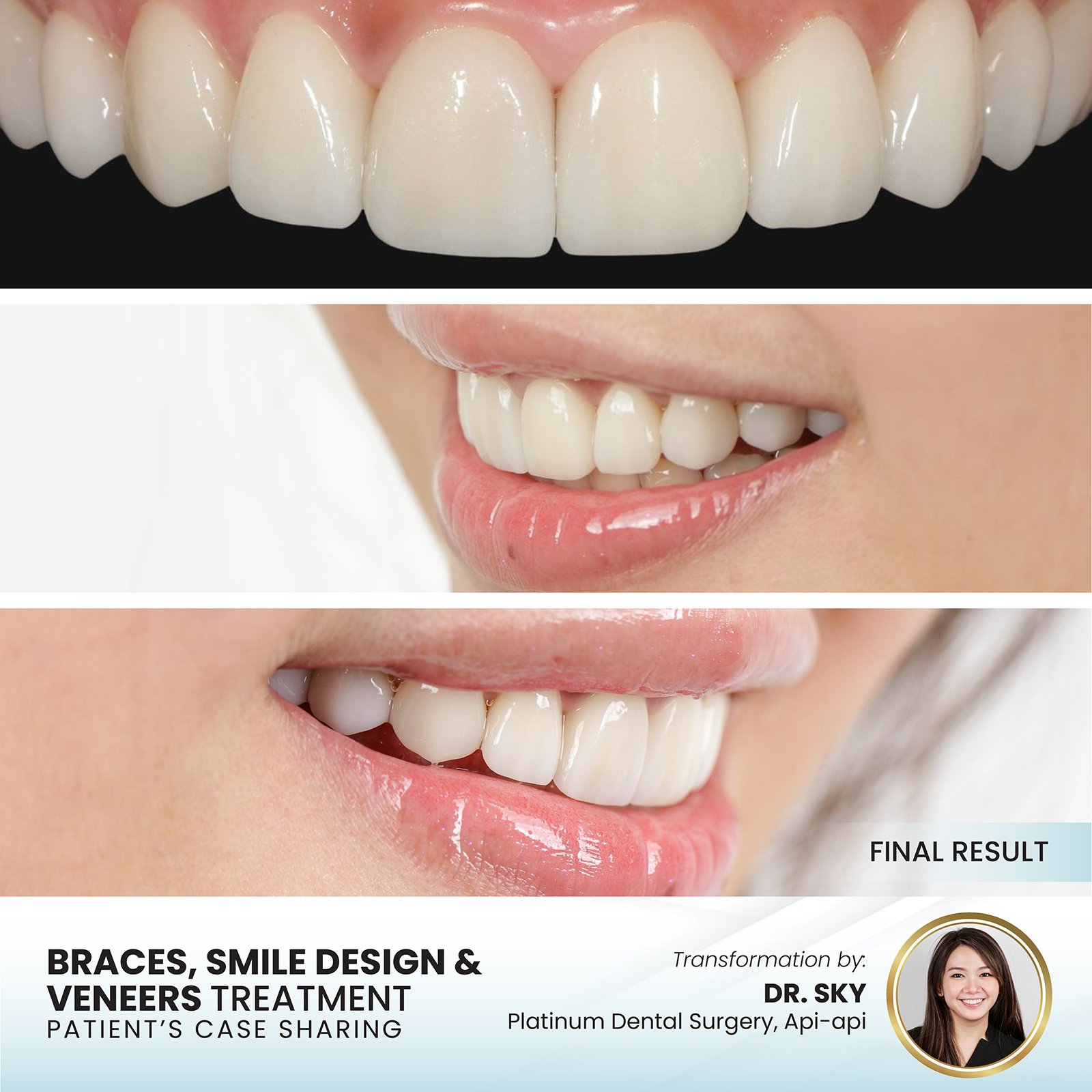 Patient smile transformation - Case III-5
