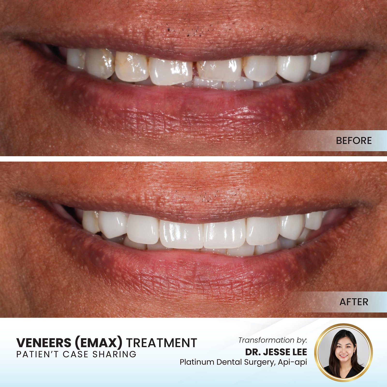 Patient smile transformation - Case III-6