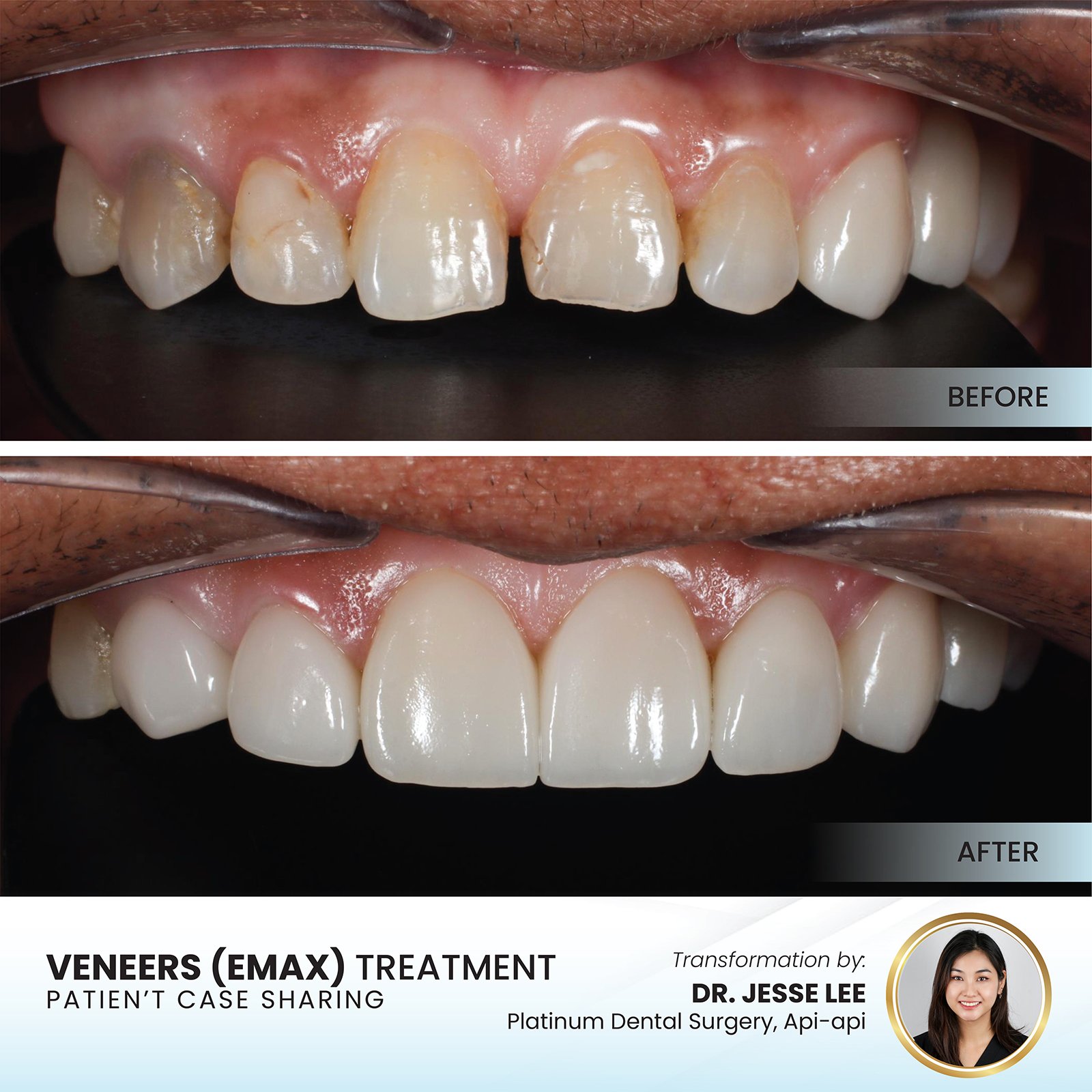 Patient smile transformation - Case III-7