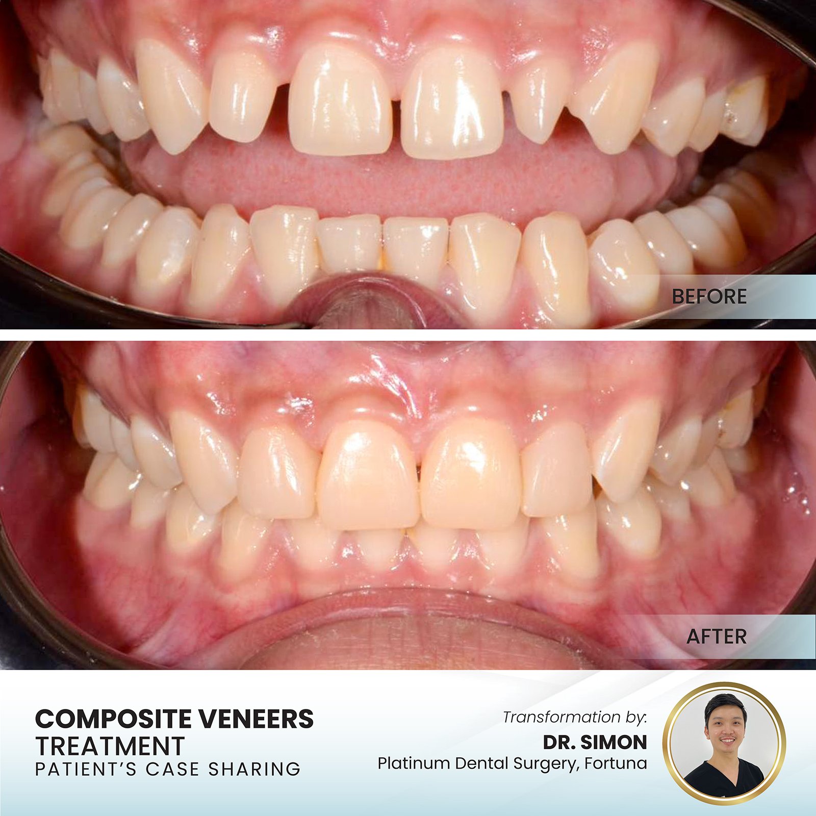 Patient smile transformation - Case III-8