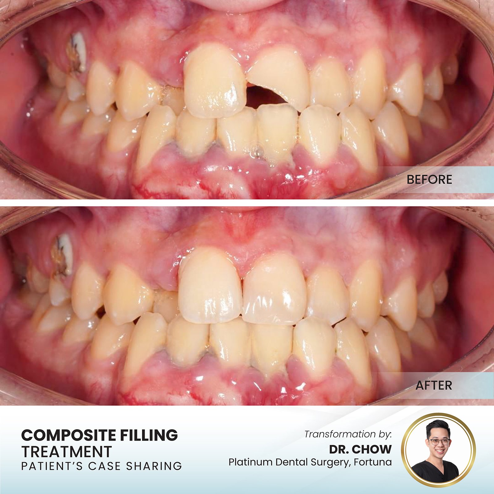 Patient smile transformation - Case III-9