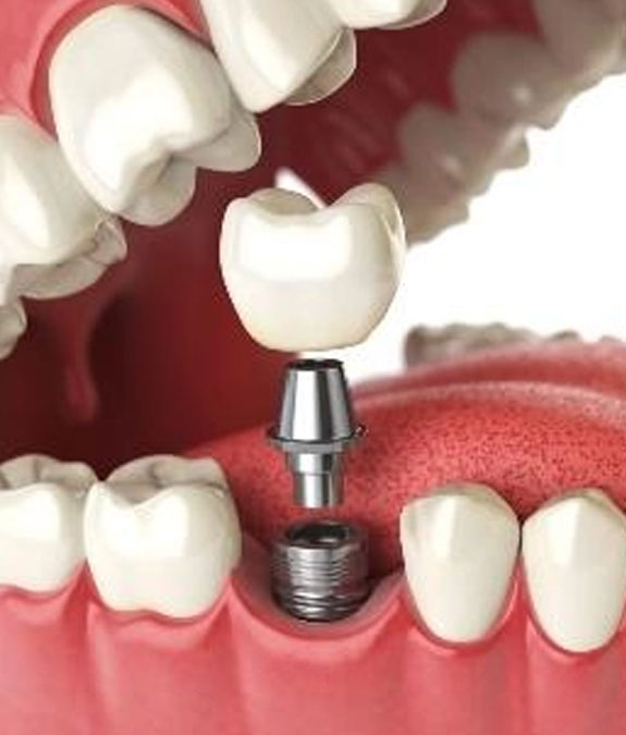Single Implant — illustrative diagram