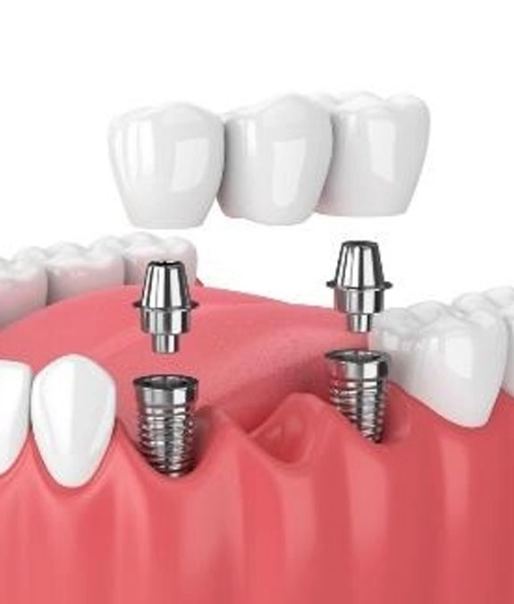 Implant-Supported Sectional Bridge — illustrative diagram