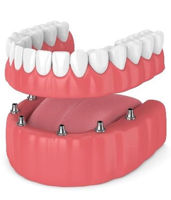 All-on-X Full Arch Rehabilitation — illustrative diagram