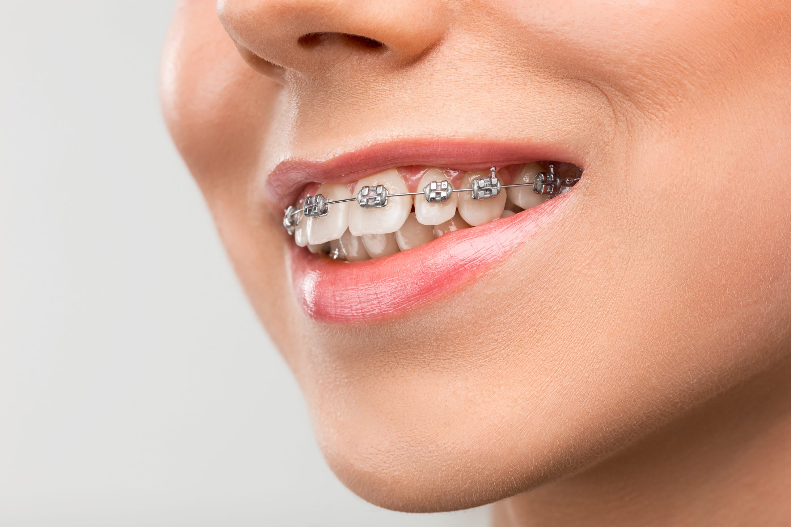 Metal Conventional Braces