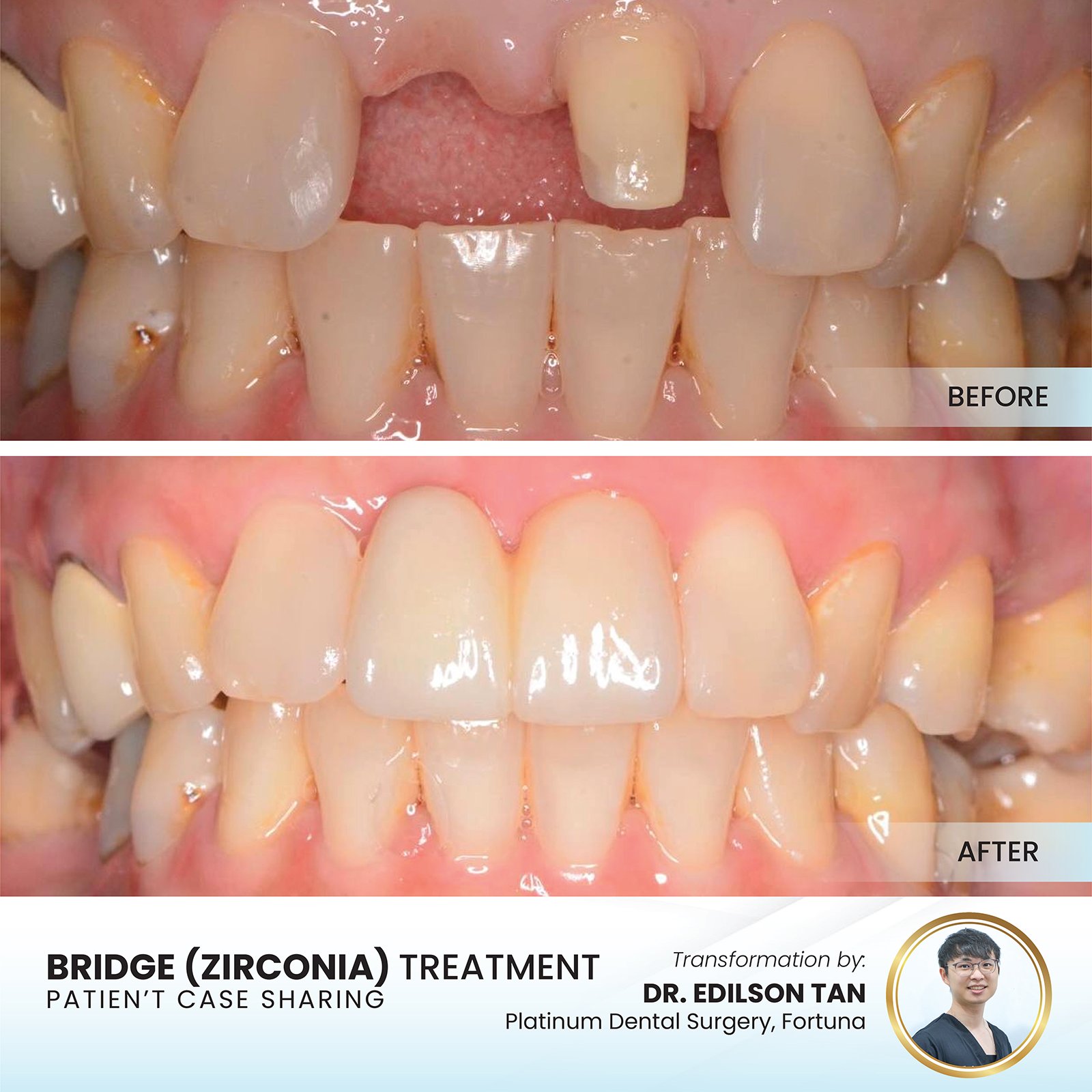 Bridge (Zirconia)
