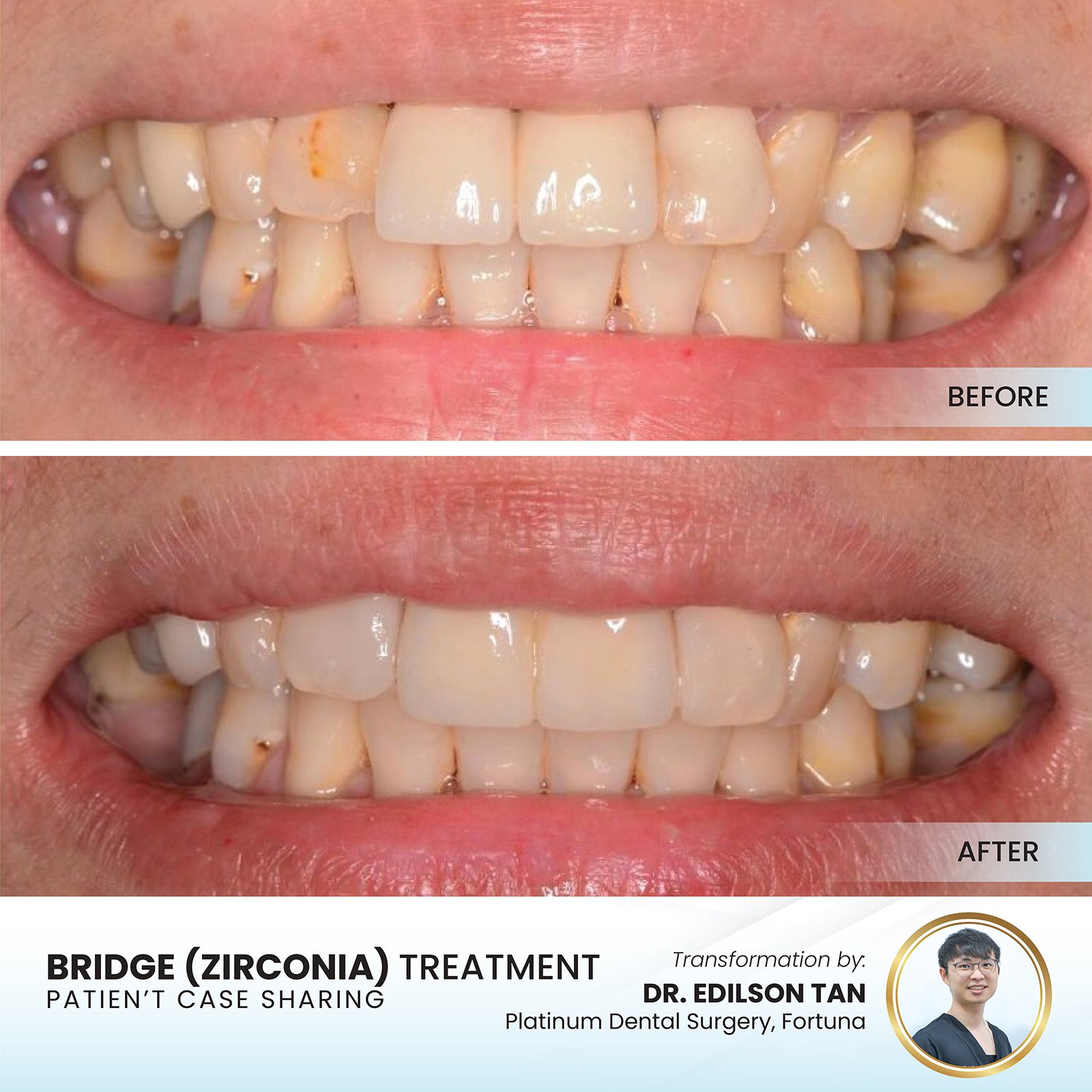 Bridge (Zirconia)