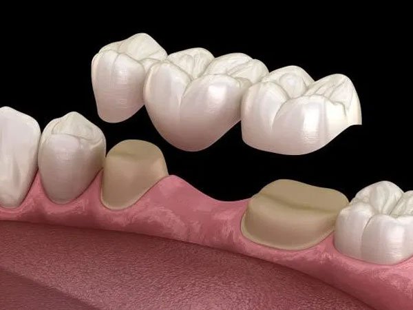 Dental Bridge