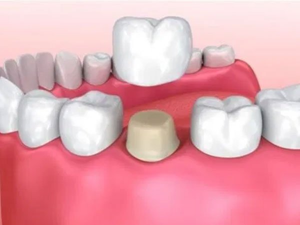 Dental Crown