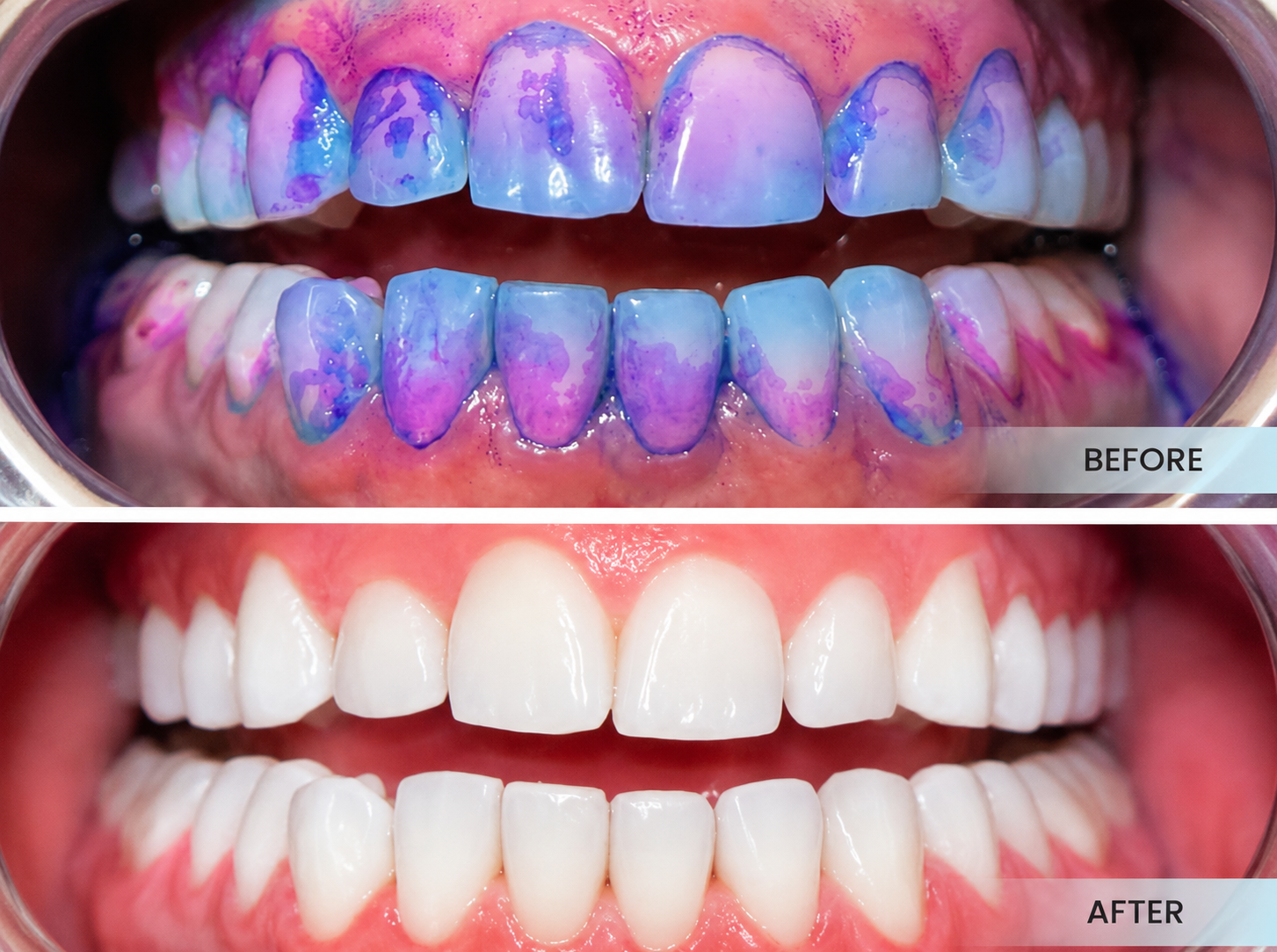 Guided Biofilm Therapy, Before & After