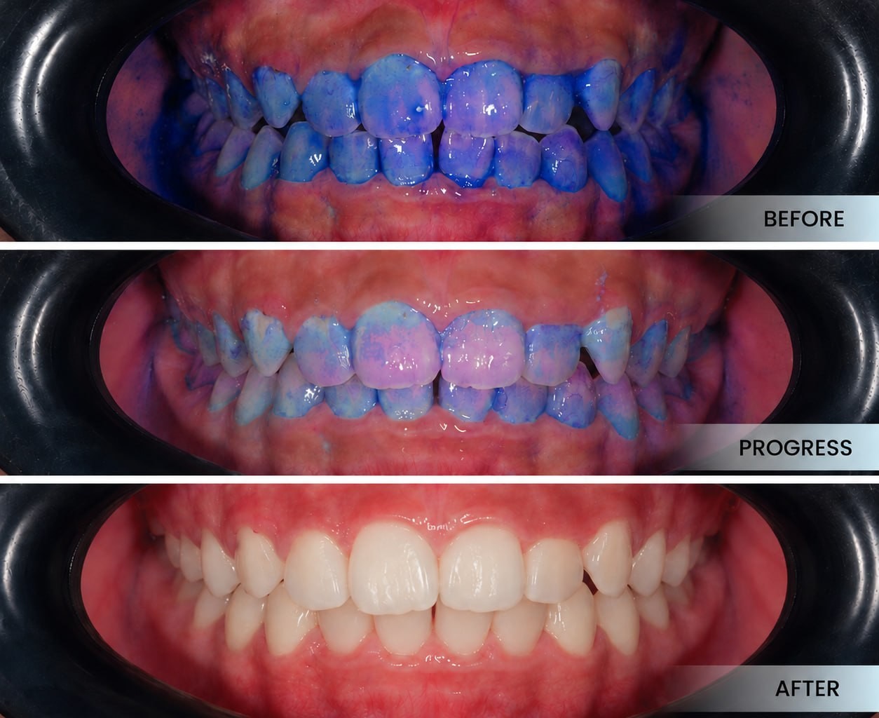 Guided Biofilm Therapy, Before & After