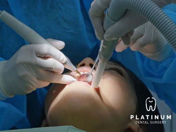 Guided Biofilm Therapy (Teeth Cleaning)