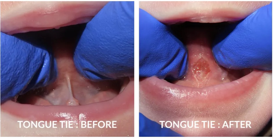 Frenectomy (Tongue-Tie & Lip-Tie Release)