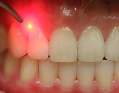 Gum Contouring & Crown Lengthening