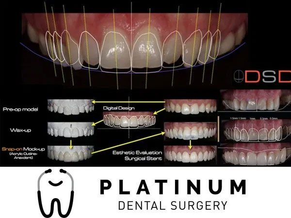 Digital Smile Design planning